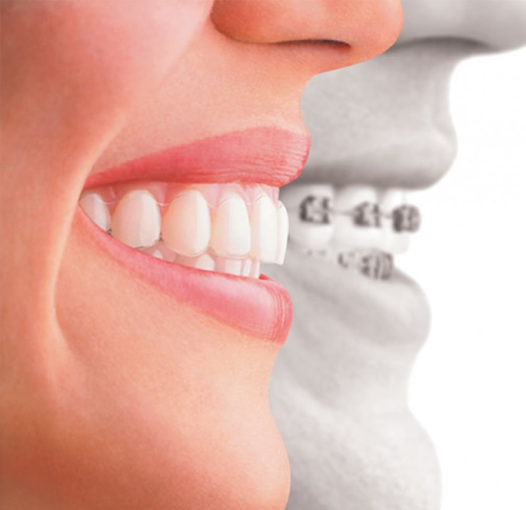 Diş Teli Tedavisi Ortodonti