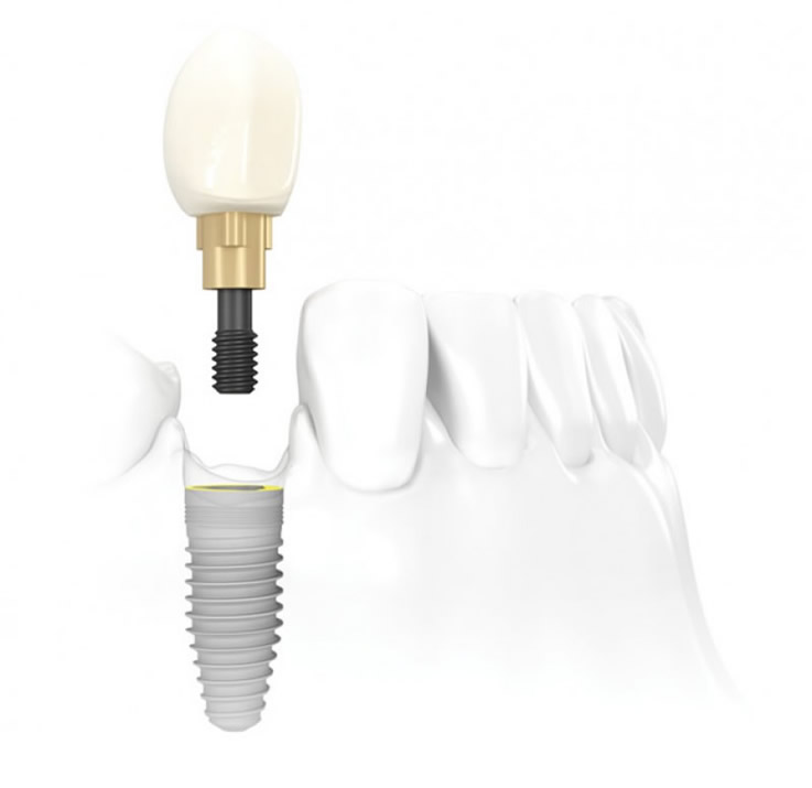 implant diş ekme